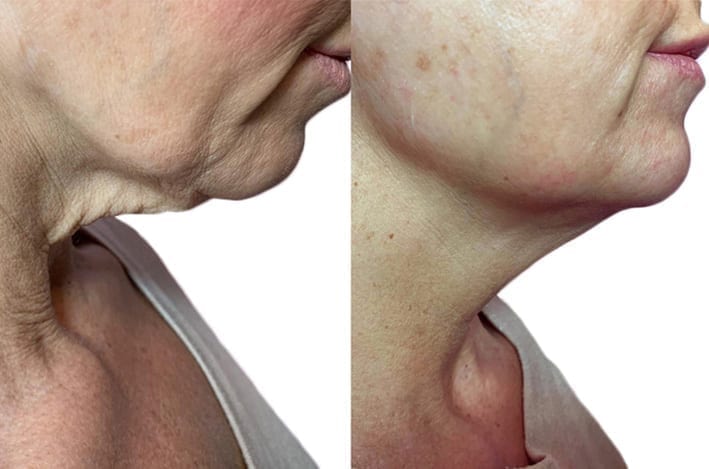 Lower Face and Neck Contouring