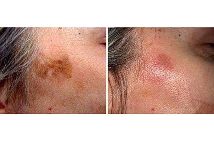 Age Spots Pigmentation