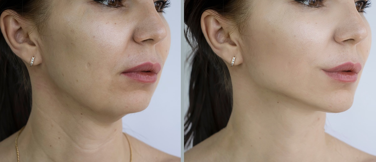 Jawline & Chin Augmentation